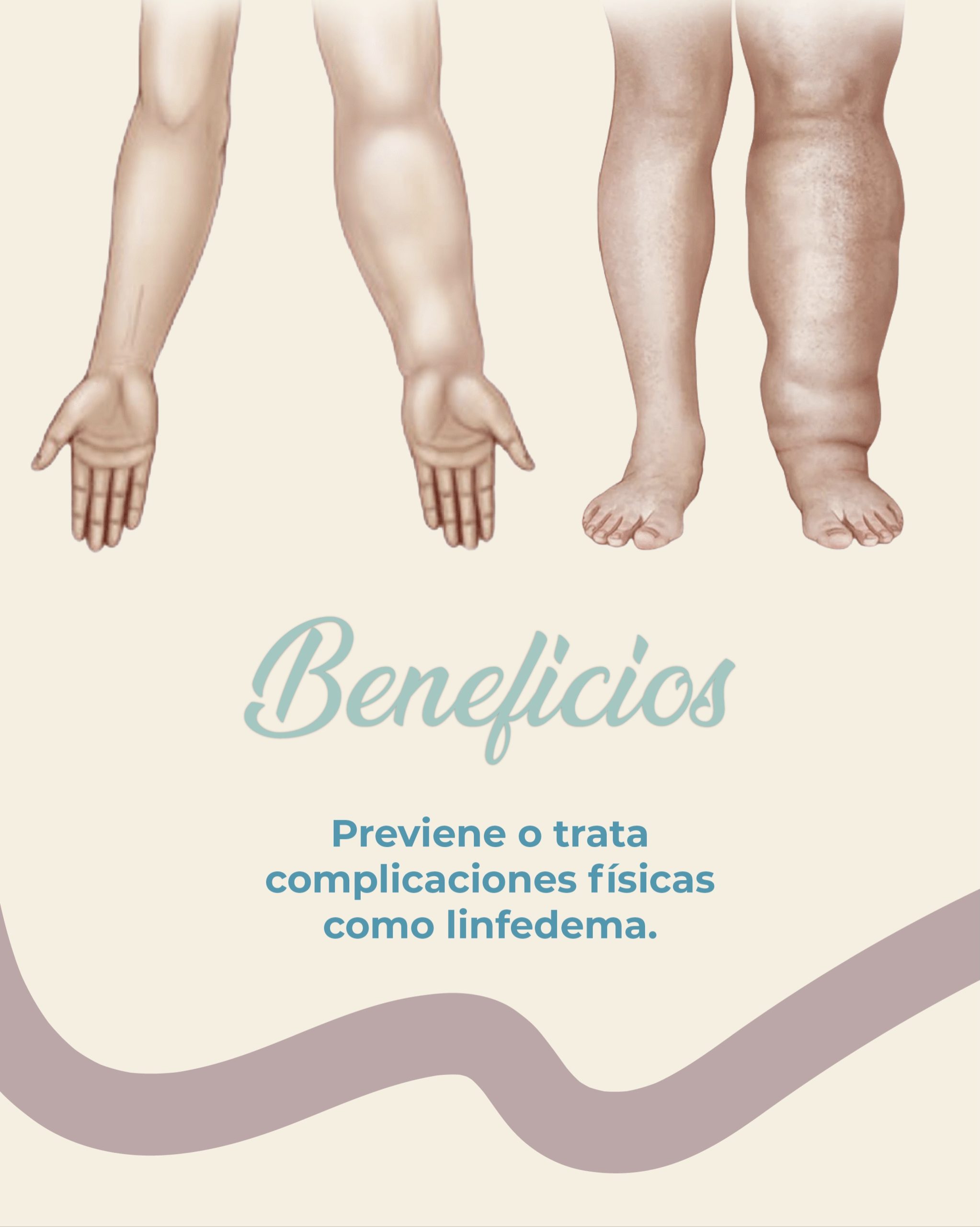 La fisioterapia oncológica no solo acompaña tu recuperación… también ayuda a prevenir y tratar complicaciones como el linfedema.
El linfedema puede aparecer después de cirugías, radioterapia o tratamientos oncológicos, generando inflamación, pesadez y molestias en brazos o piernas.
Con un abordaje especializado, la fisioterapia oncológica ayuda a:
•Prevenir la aparición del linfedema
•Disminuir inflamación y sensación de pesadez
•Mejorar la movilidad y la circulación
•Reducir dolor y tensión
•Mejorar la calidad de vida durante y después del tratamiento

Cada proceso es diferente, por eso el acompañamiento profesional marca la diferencia 💚

📍 Mall Dorado, Goicoechea
📲 8707-8837