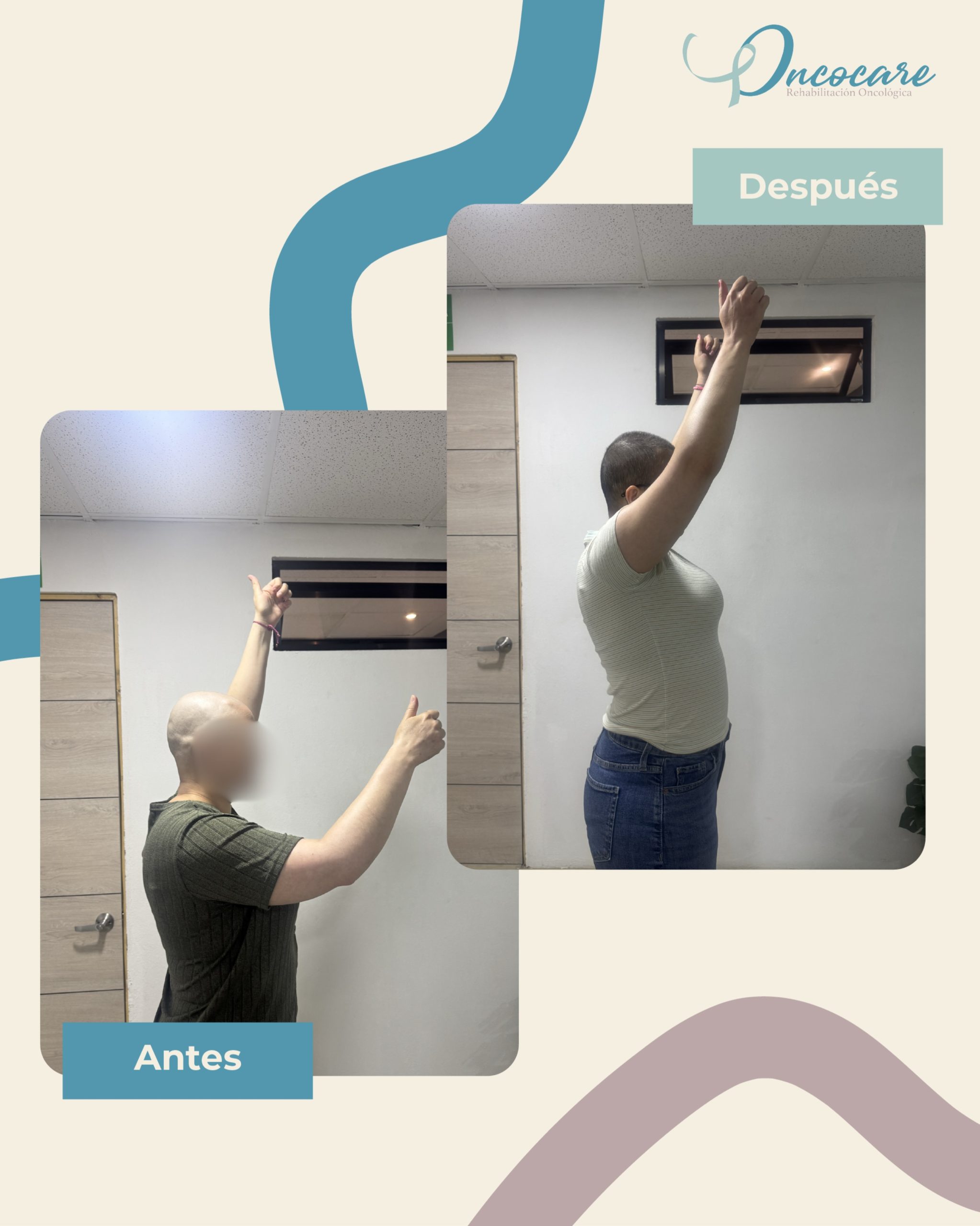 ANTES ➡️ DESPUÉS
Después de una mastectomía, es común presentar limitación de movilidad, rigidez y temor a mover el brazo.
Con fisioterapia especializada trabajamos progresivamente para recuperar movilidad, fuerza, función y confianza en el movimiento. 🩷
En Oncocare nos enfocamos en que cada proceso sea individualizado.
Cada avance cuenta. Cada movimiento recuperado también.
Citas e información: 8707-8837
🏡 Mall el Dorado, Goicoechea.
#fisioterapiaoncológica #oncocarecr #cáncerdemama #ejerciciofísico #sanjosecr