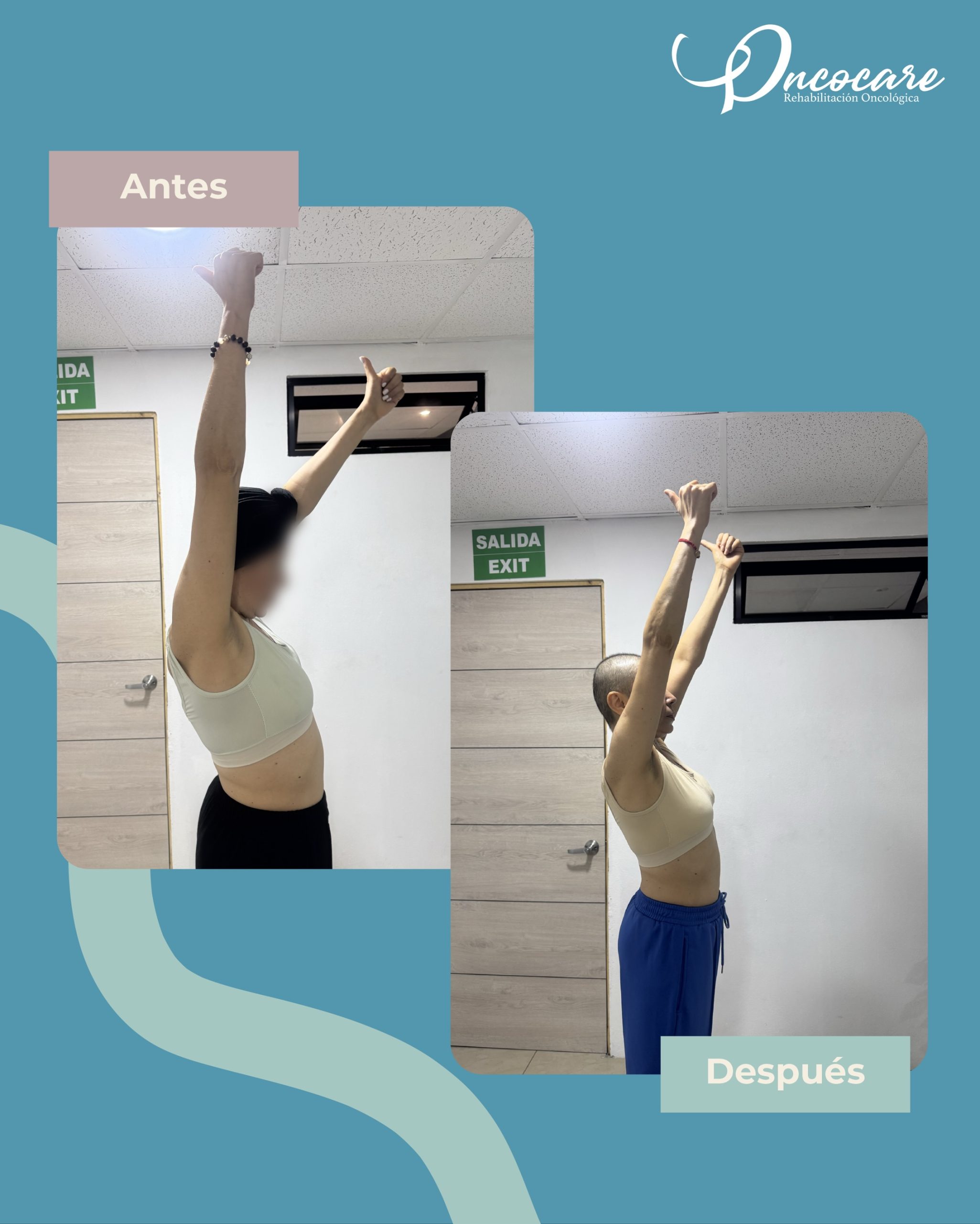 Antes y después de la rehabilitación post mastectomía✨
Después de una mastectomía, recuperar el movimiento del brazo y del hombro puede ser parte importante del proceso de recuperación.
A través de la fisioterapia trabajamos de manera individualizada aspectos como la movilidad, fuerza, rigidez, dolor y función del miembro superior, respetando siempre el proceso y las necesidades de cada paciente.
Este cambio no representa solo unos grados más de movimiento. Representa volver poco a poco a las actividades de la vida diaria con mayor seguridad y confianza.
En Oncocare te acompañamos durante tu proceso de recuperación. 🌿
📲 Agenda tu valoración: 8707-8837
📍 Guadalupe, Mall Dorado
#oncocarecr #rehabilitacion #cáncerdemama #fisioterapiaoncológica #sanjosecr